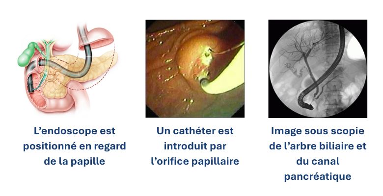 Endoscopische Cholangio Pancreatografie ECP H pital Erasme