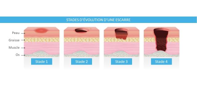 Les stades d'évolution d'une escarre - Hôpital Erasme H.U.B