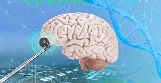 Stimulation Cérébrale Profonde Illu Hôpital Universitaire de Bruxelles