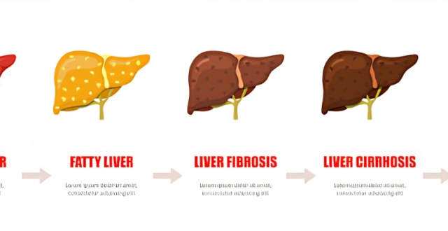 Stades de dégradation du foie - Illustration Getty Credit GrayJay