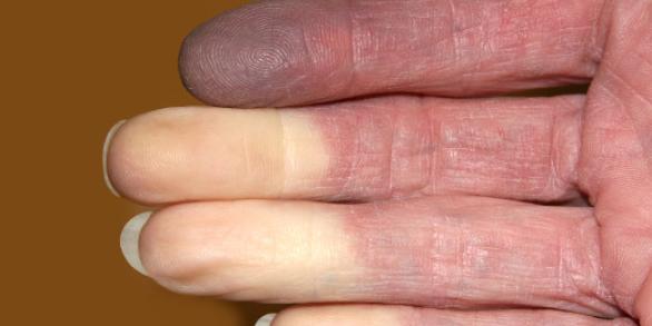 maladie de raynaud