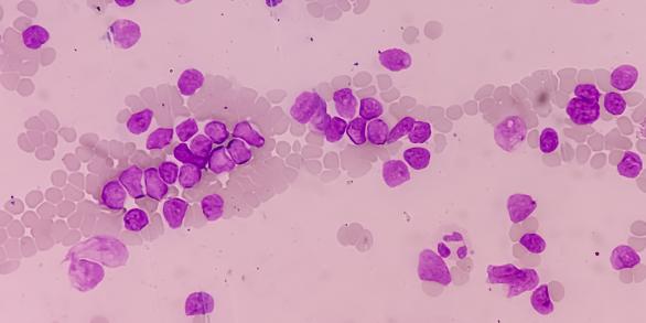 mastocytose systémique