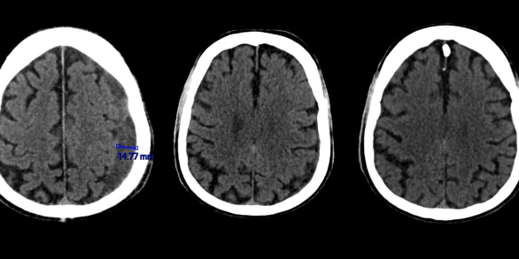 Hôpital Erasme - Symposium de NeuroRadiologie Interventionnelle 2024