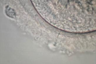 Clinique de la Fertilité - Insémination Ovocyte - Hôpital Universitaire de Bruxelles