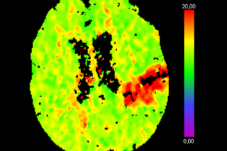 AVC Image - Hôpital Universitaire de Bruxelles, Clinique Neurovasculaire