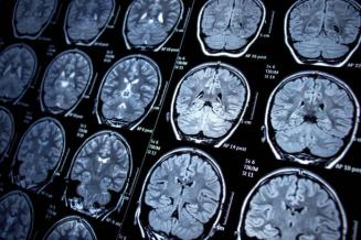 Clinique d'épilepsie - Hôpital Erasme H.U.B - Illu scan cerveau