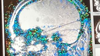 Visualisation du cerveau avec fibre LITT implantée