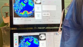 visualisation cérébrale avant activation de la LITT pour éliminer les tissus atteints dans le foyer épileptogène