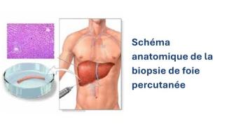 Biopsie du foie par voie percutanée - schéma anatomique - Clinique d'Endoscopie - Hôpital Universitaire de Bruxelles
