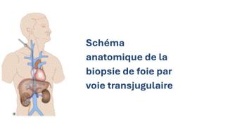 Biopsie du foie par voie transjugulaire - Schéma anatomique - Clinique d'Endoscopie - Hôpital Universitaire de Bruxelles