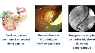 Cholangio-Pancréatographie Endoscopique (CPE) - Illustrations - Clinique d'Endoscopie - Hôpital Universitaire de Bruxelles