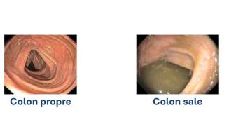 Colon propre et colon sale - Images - Clinique d'Endoscopie - Colonoscopie - Hôpital Universitaire de Bruxelles