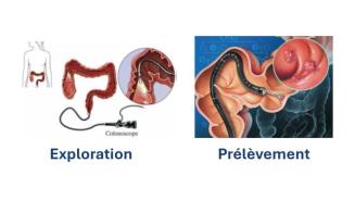 Colonoscopie - Exploration endoscope et prélèvement - Clinique d'Endoscopie - Hôpital Universitaire de Bruxelles