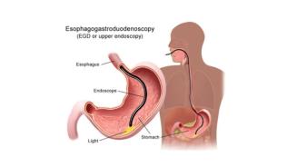 Gastroscopie - Schéma - Clinique d'Endoscopie - Hôpital Universitaire de Bruxelles